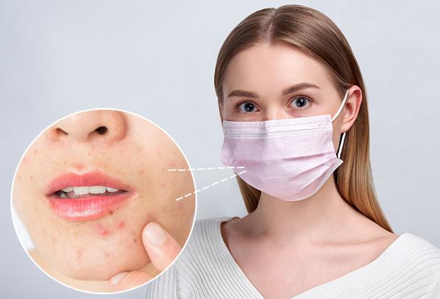 Come riconoscere la maskne? Come riconoscere la maskne?